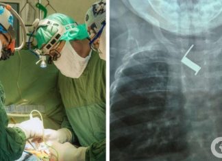 Две недели лечили от «бронхита»: в Одессе спасли младенца, проглотившего пружину. Фото