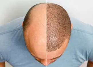 Пересадка волос: все что стоит знать — основные аспекты и процесс